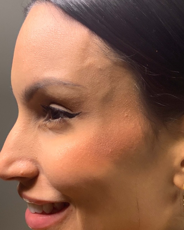 Botox Before & After Image