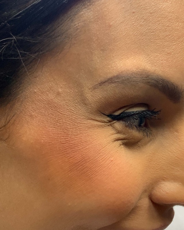 Botox Before & After Image