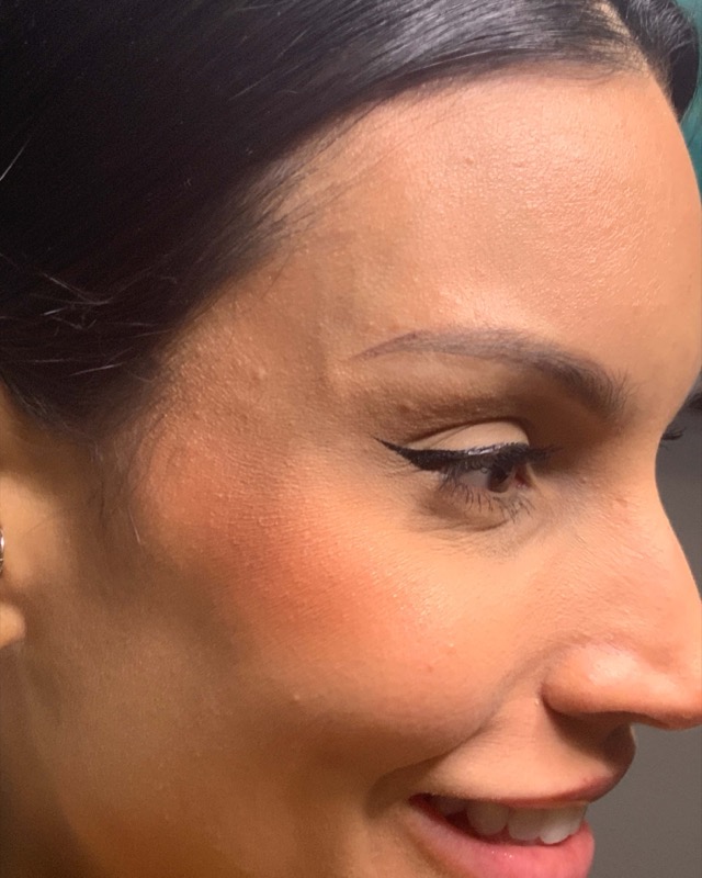 Botox Before & After Image