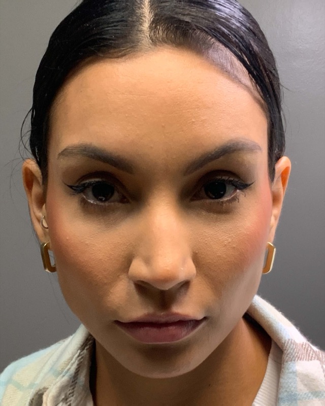 Botox Before & After Image