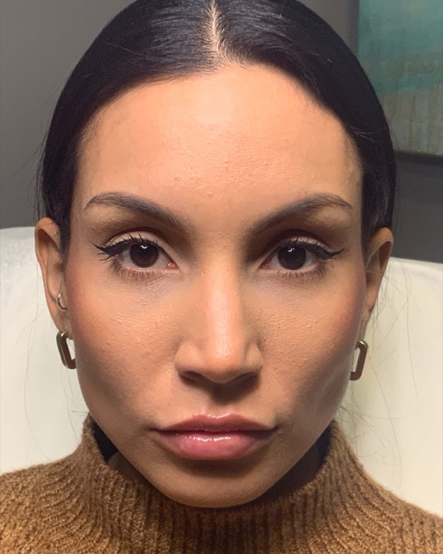 Botox Before & After Image
