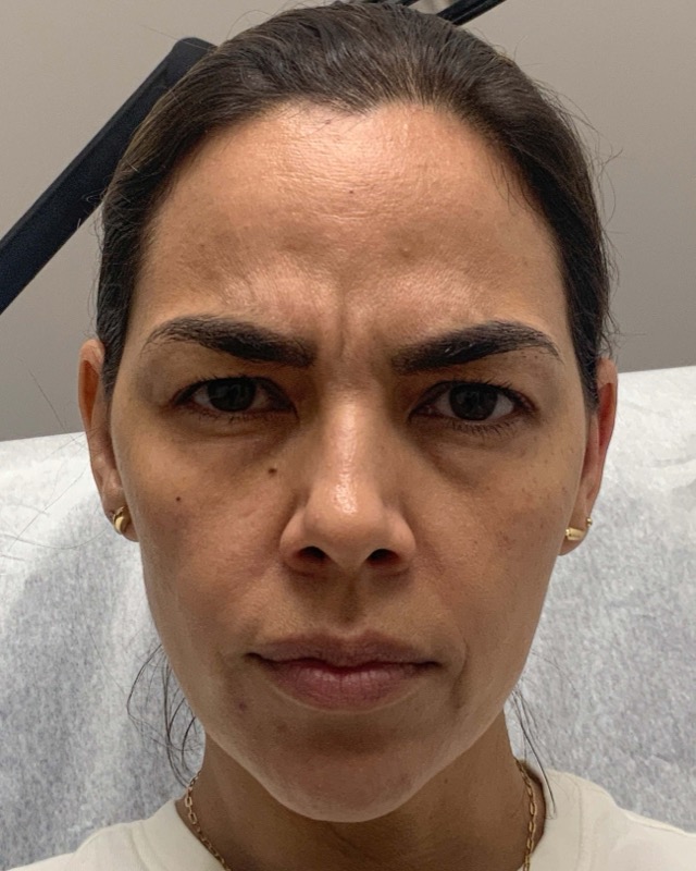 Botox Before & After Image