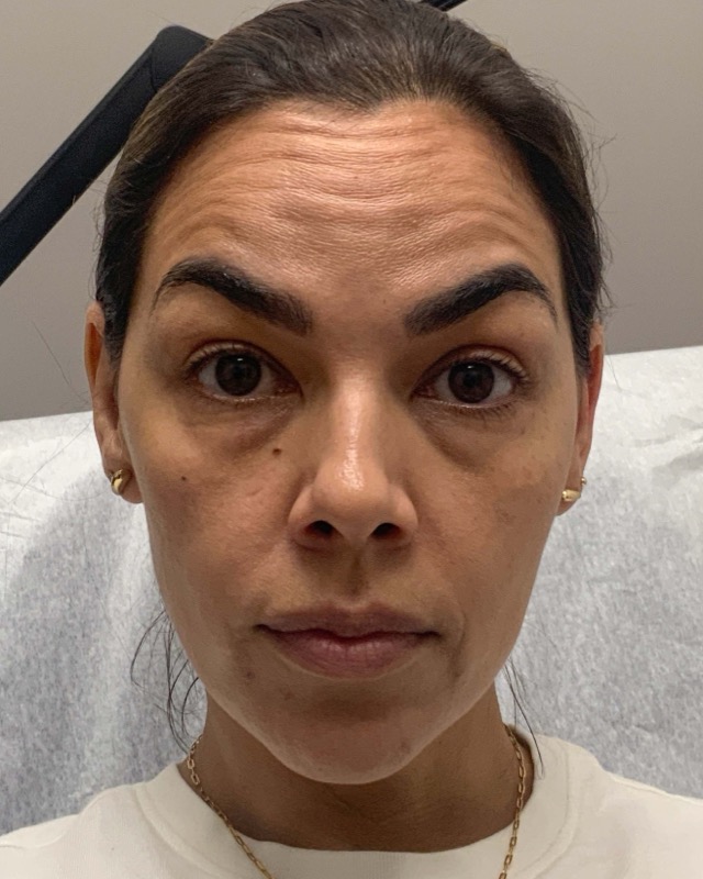 Botox Before & After Image