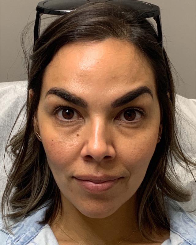 Botox Before & After Image