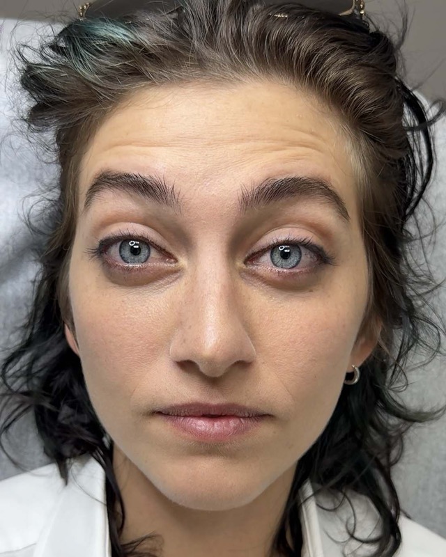 Botox Before & After Image