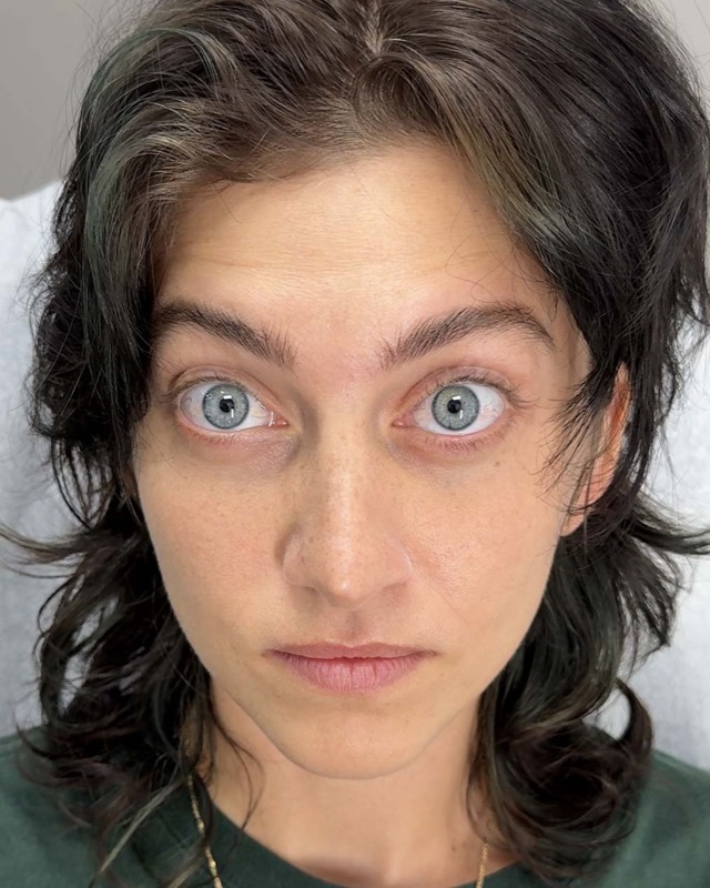 Botox Before & After Image