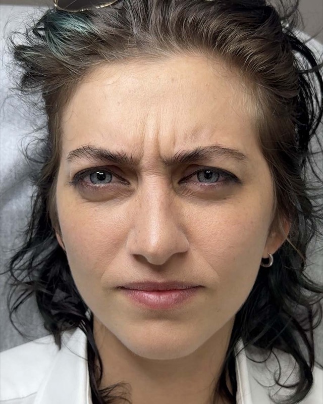 Botox Before & After Image