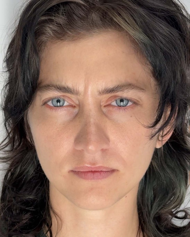 Botox Before & After Image