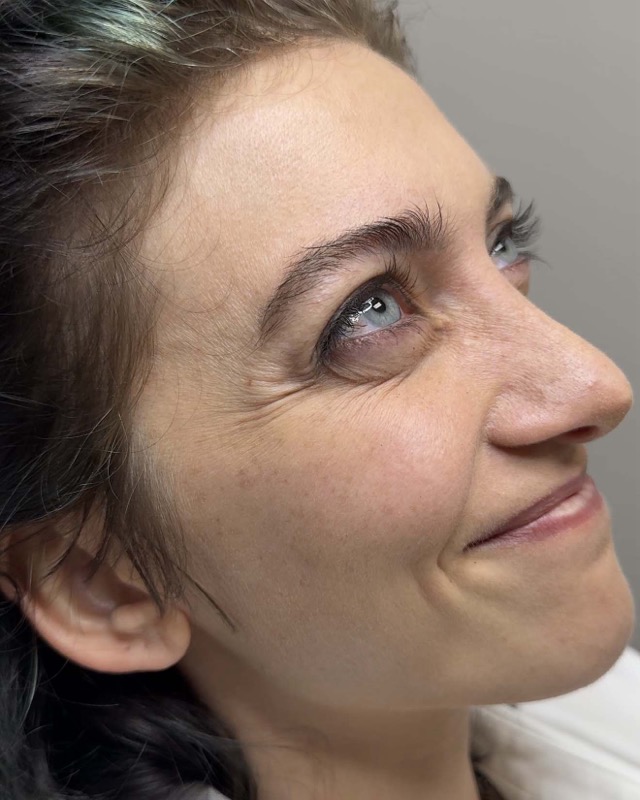 Botox Before & After Image