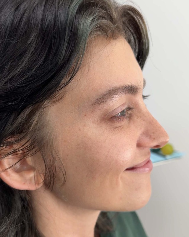 Botox Before & After Image