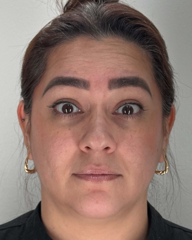 Botox Before & After Image