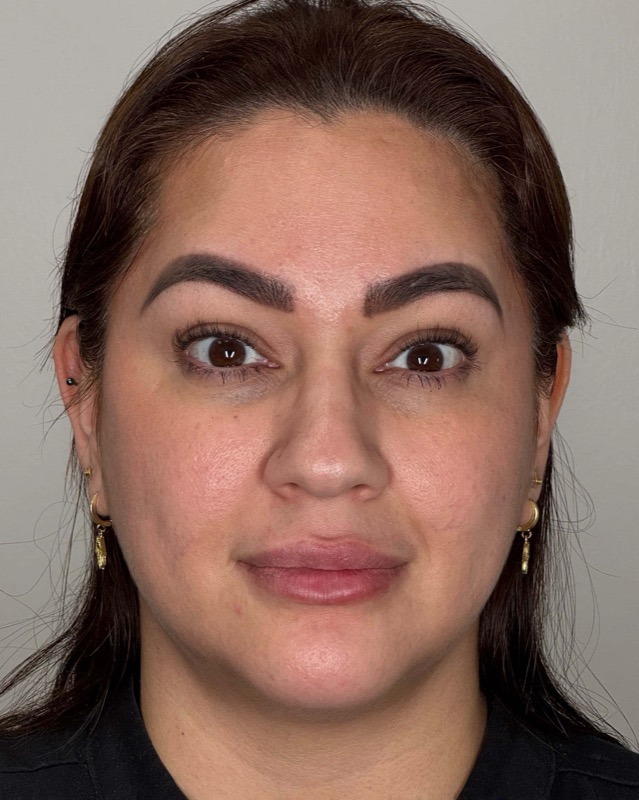 Botox Before & After Image