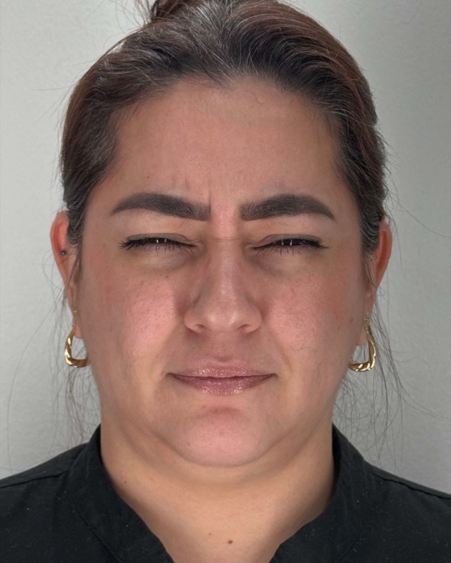Botox Before & After Image