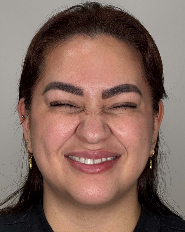 Botox Before & After Image