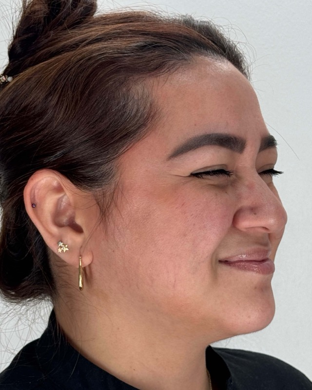 Botox Before & After Image