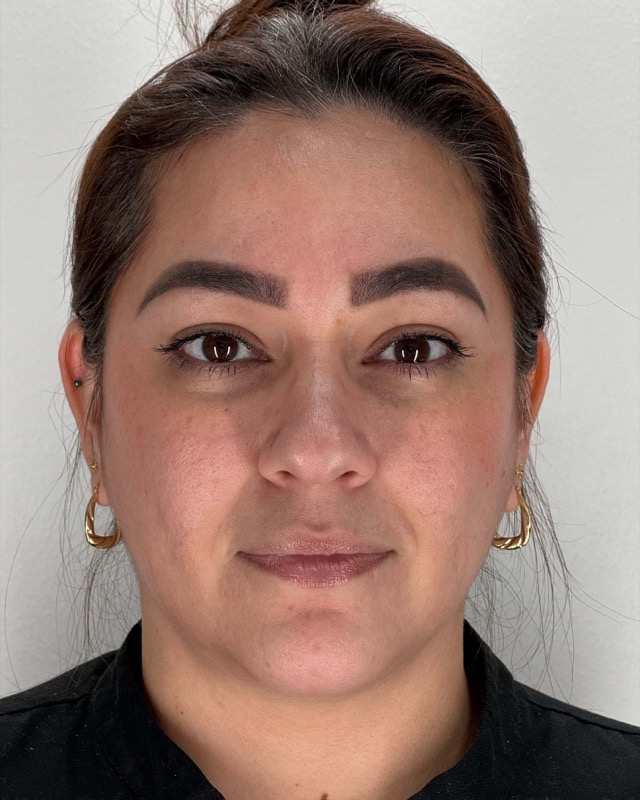 Botox Before & After Image