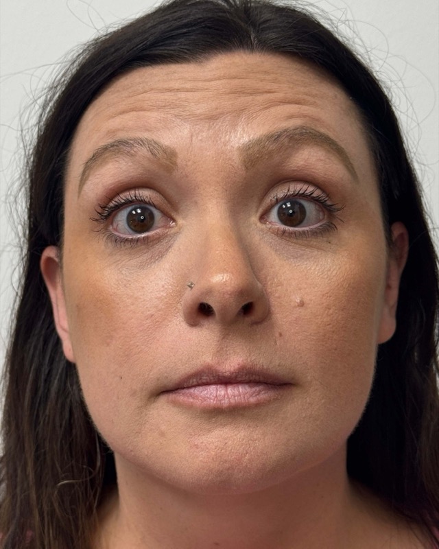 Botox Before & After Image
