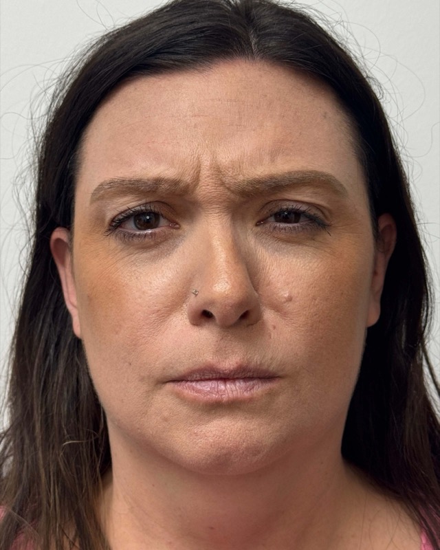 Botox Before & After Image