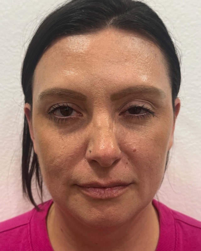 Botox Before & After Image