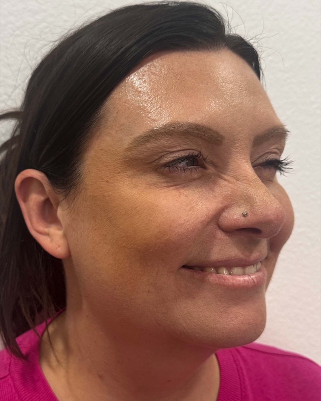 Botox Before & After Image