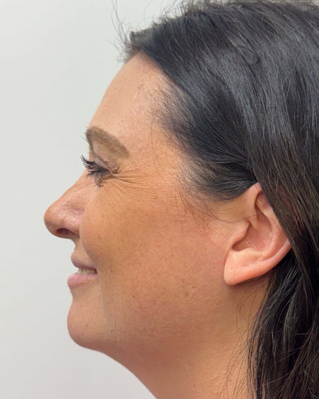 Botox Before & After Image