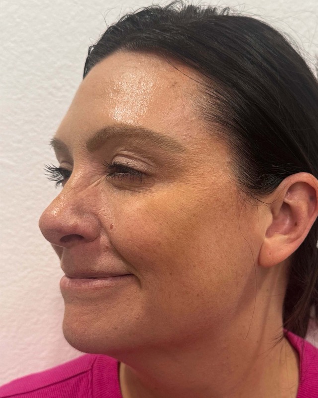 Botox Before & After Image