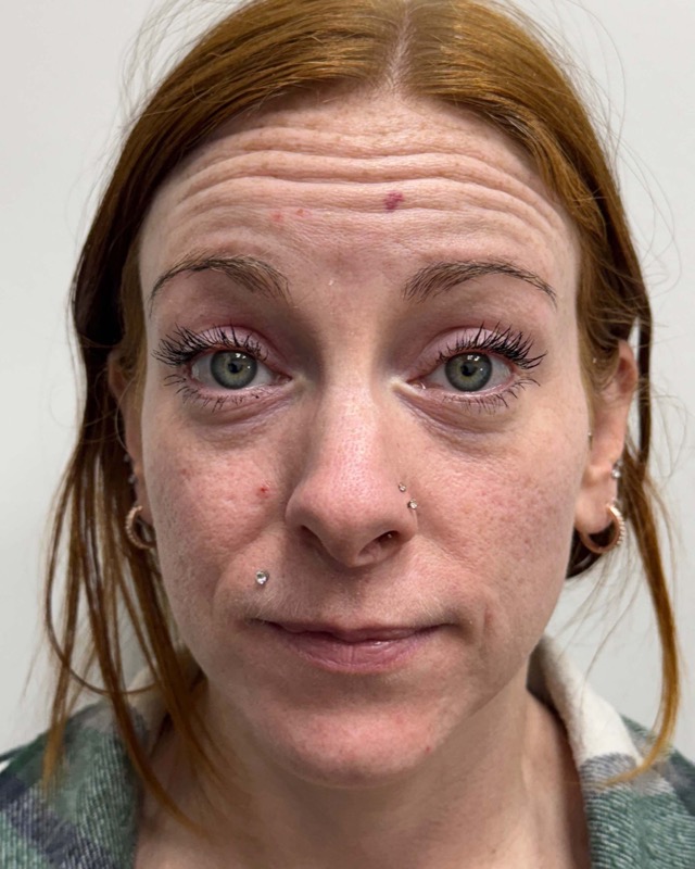 Botox Before & After Image