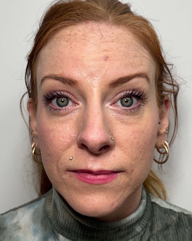 Botox Before & After Image