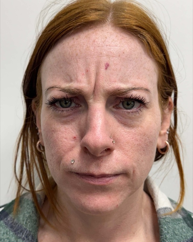 Botox Before & After Image