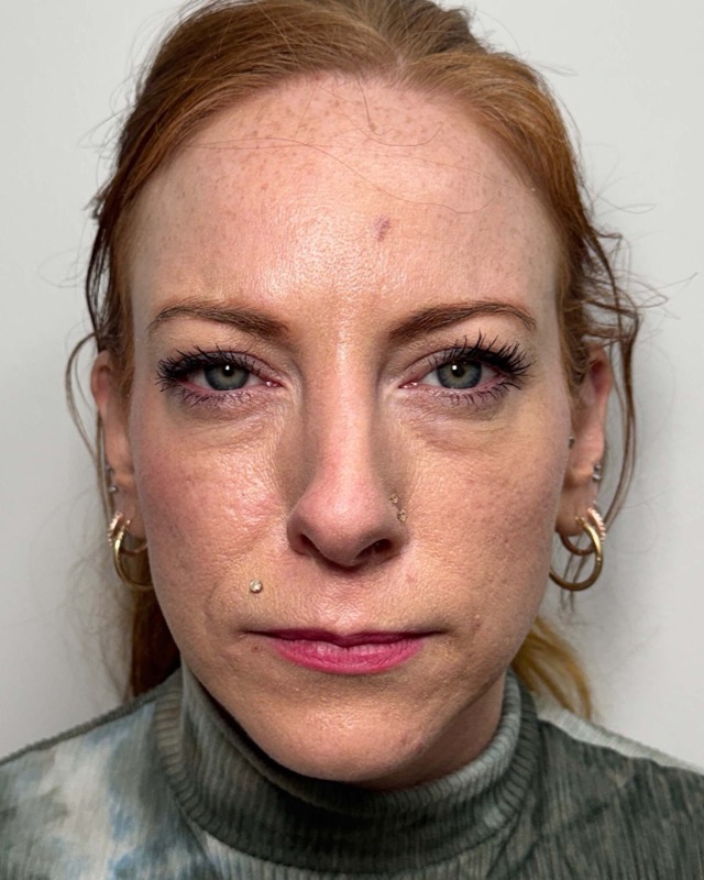 Botox Before & After Image