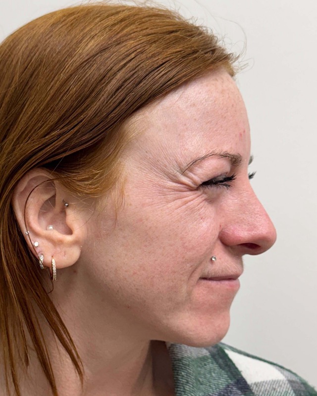 Botox Before & After Image