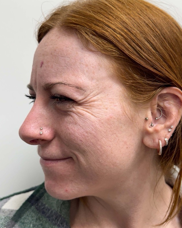 Botox Before & After Image