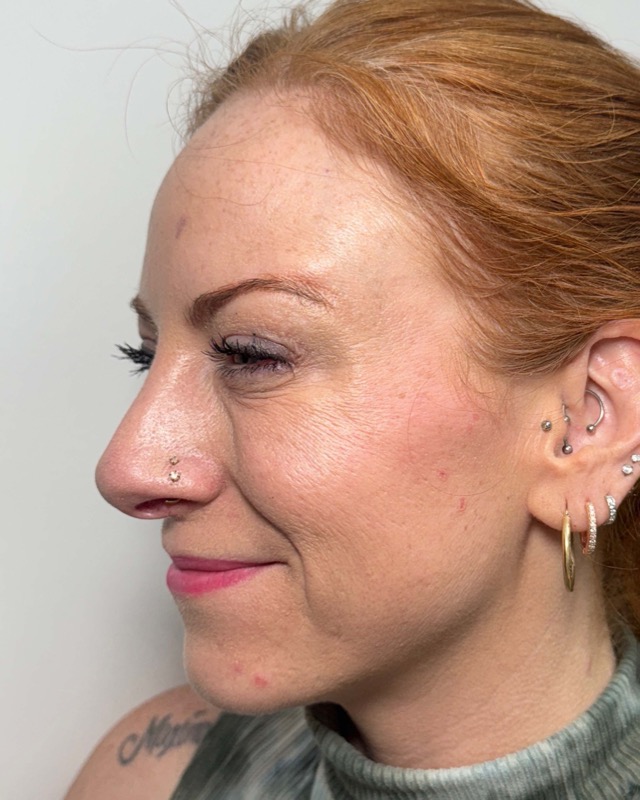 Botox Before & After Image