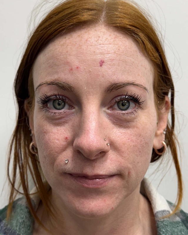 Botox Before & After Image