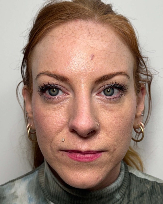 Botox Before & After Image