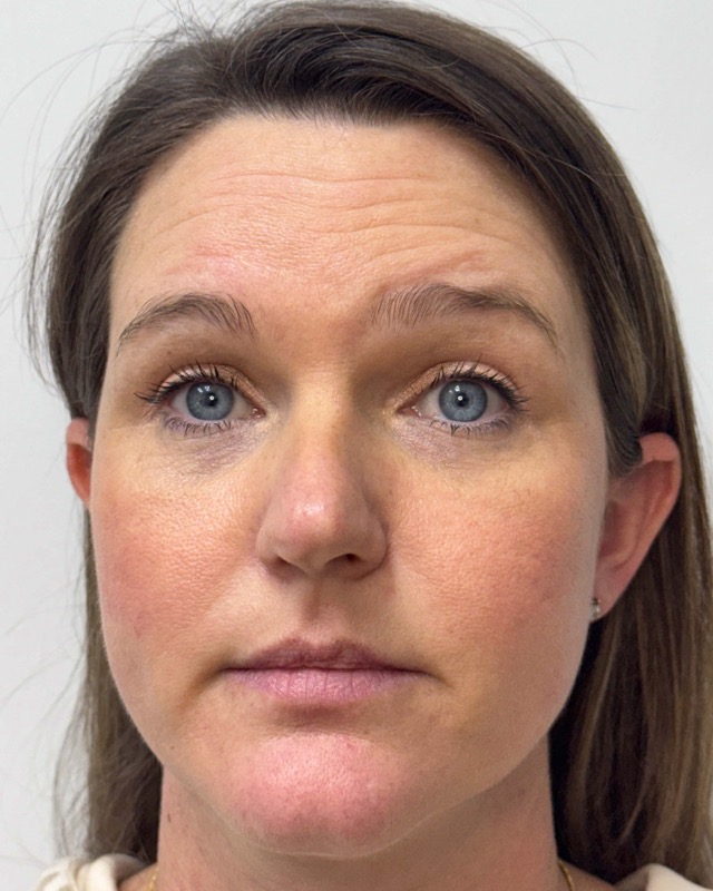 Botox Before & After Image