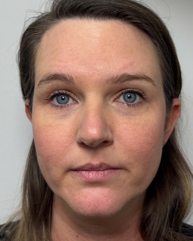 Botox Before & After Image