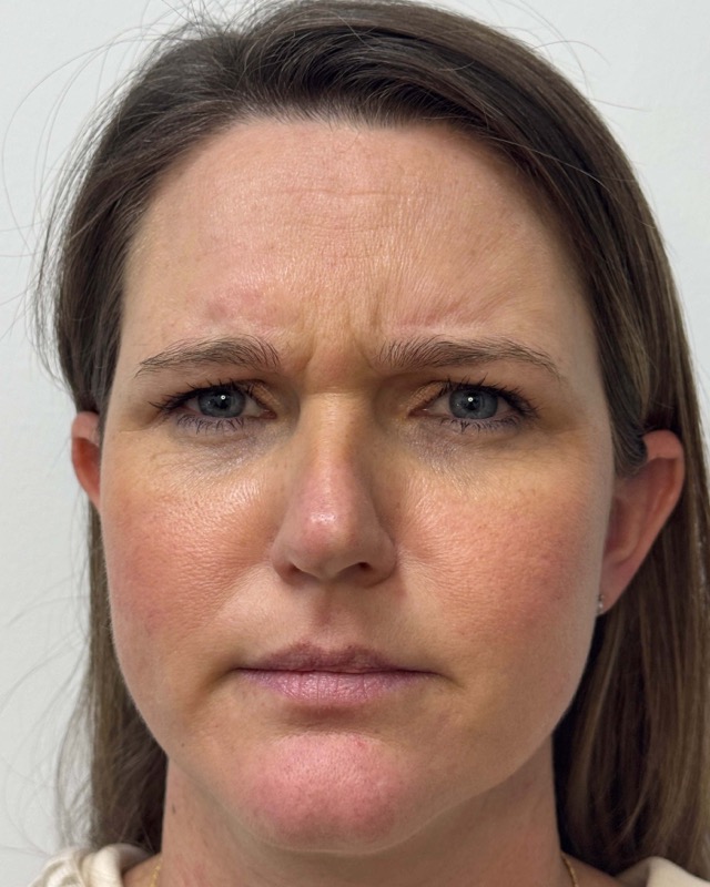 Botox Before & After Image