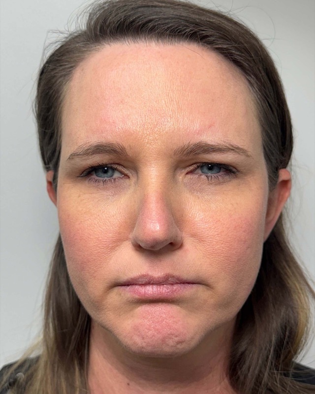 Botox Before & After Image