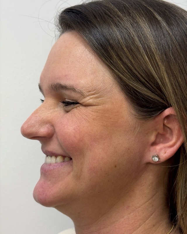 Botox Before & After Image