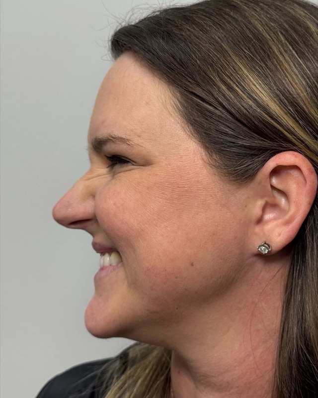 Botox Before & After Image