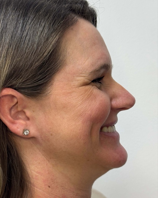 Botox Before & After Image