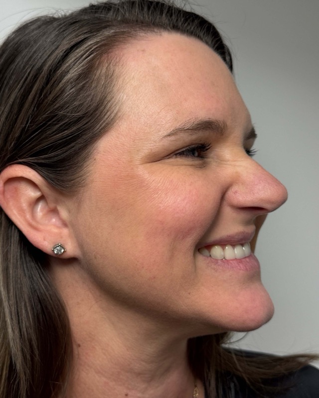 Botox Before & After Image