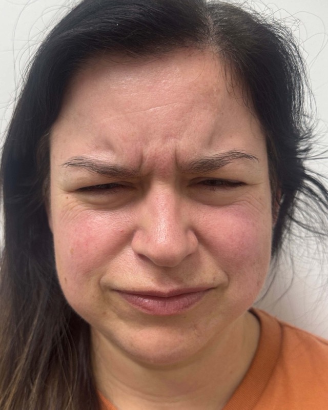 Botox Before & After Image