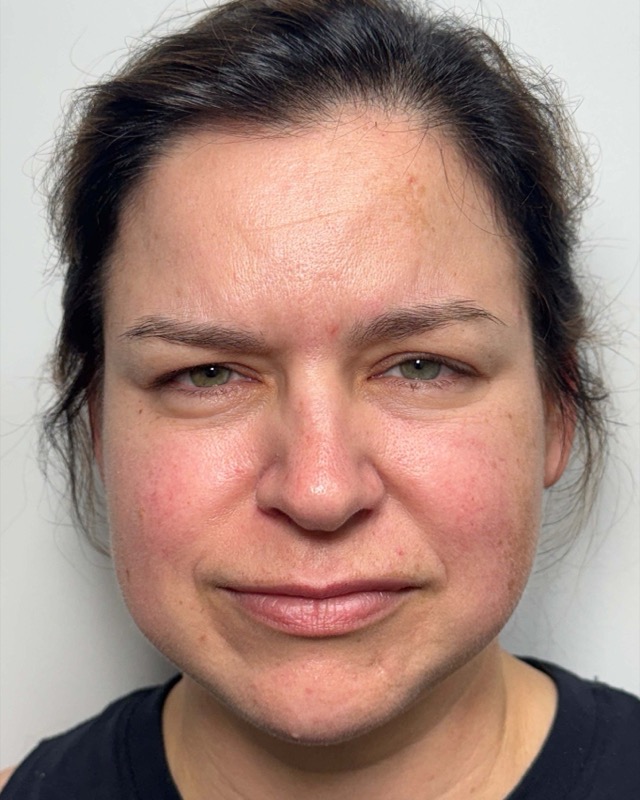 Botox Before & After Image