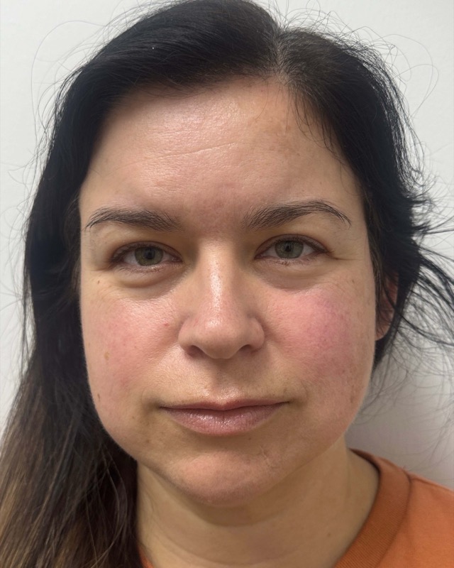 Botox Before & After Image