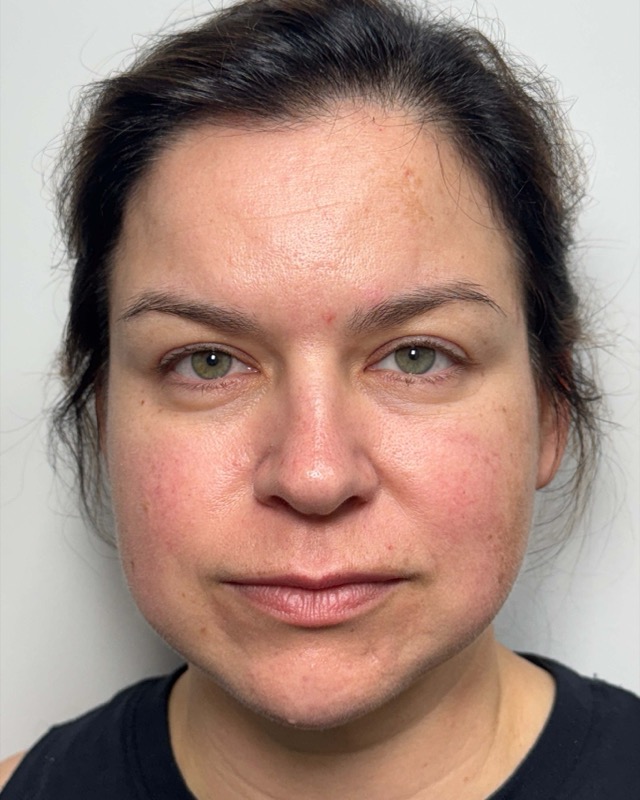 Botox Before & After Image