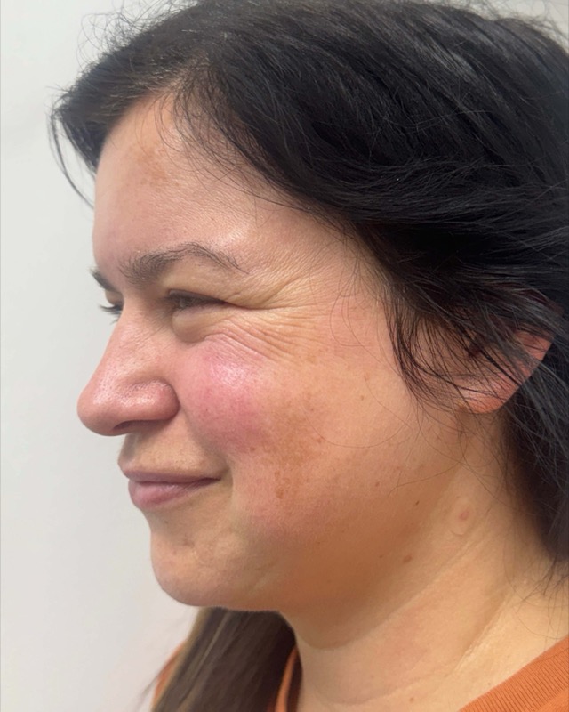 Botox Before & After Image