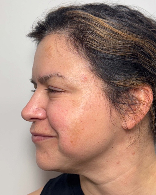 Botox Before & After Image