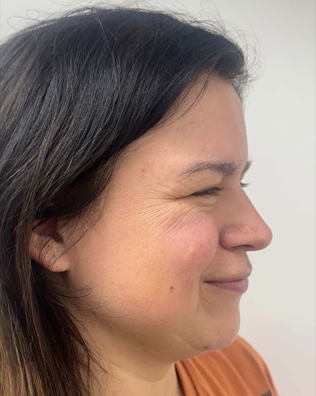 Botox Before & After Image